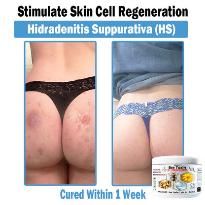 ODALIT™✨ Bee Toxin Multi-Symptom Skin Treatment Cream (👨‍⚕NPF RECOMMENDS)