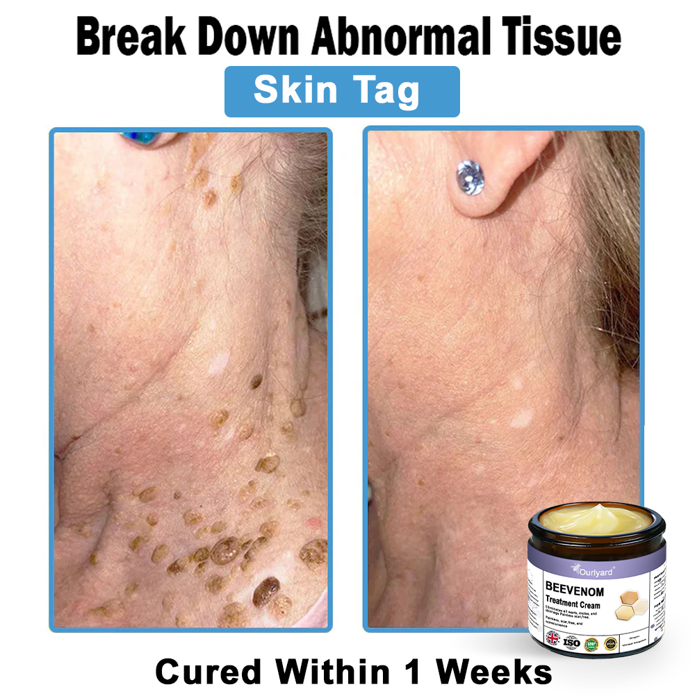 Ourlyard® Bee Venom Skin Treatment Cream👨‍⚕️Treats warts, growths, infections, and scars, smooths uneven skin, and is certified by the British Association of Dermatologists (BAD)