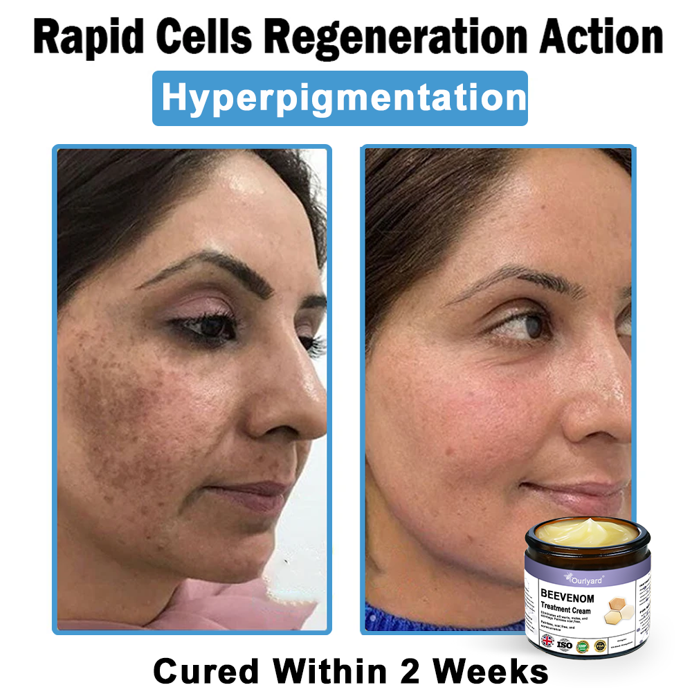 Ourlyard® Bee Venom Skin Treatment Cream👨‍⚕️Treats warts, growths, infections, and scars, smooths uneven skin, and is certified by the British Association of Dermatologists (BAD)