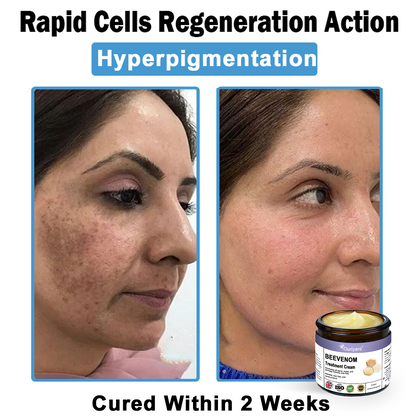 Ourlyard® Bee Venom Skin Treatment Cream👨‍⚕️Treats warts, growths, infections, and scars, smooths uneven skin, and is certified by the British Association of Dermatologists (BAD)
