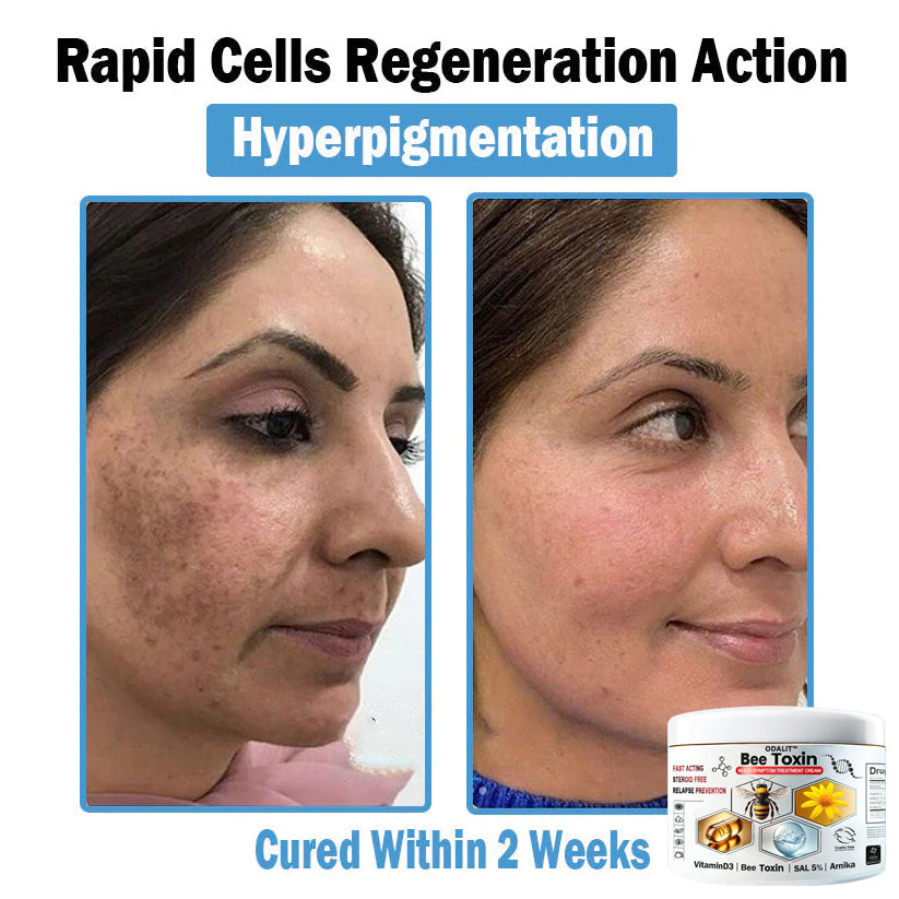 ODALIT™✨ Bee Toxin Multi-Symptom Skin Treatment Cream (👨‍⚕NPF RECOMMENDS)
