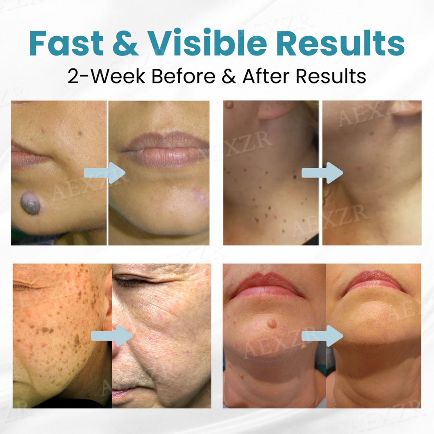 ODALIT™ Non-Invasive Mole and Wart Removal Laser Pen