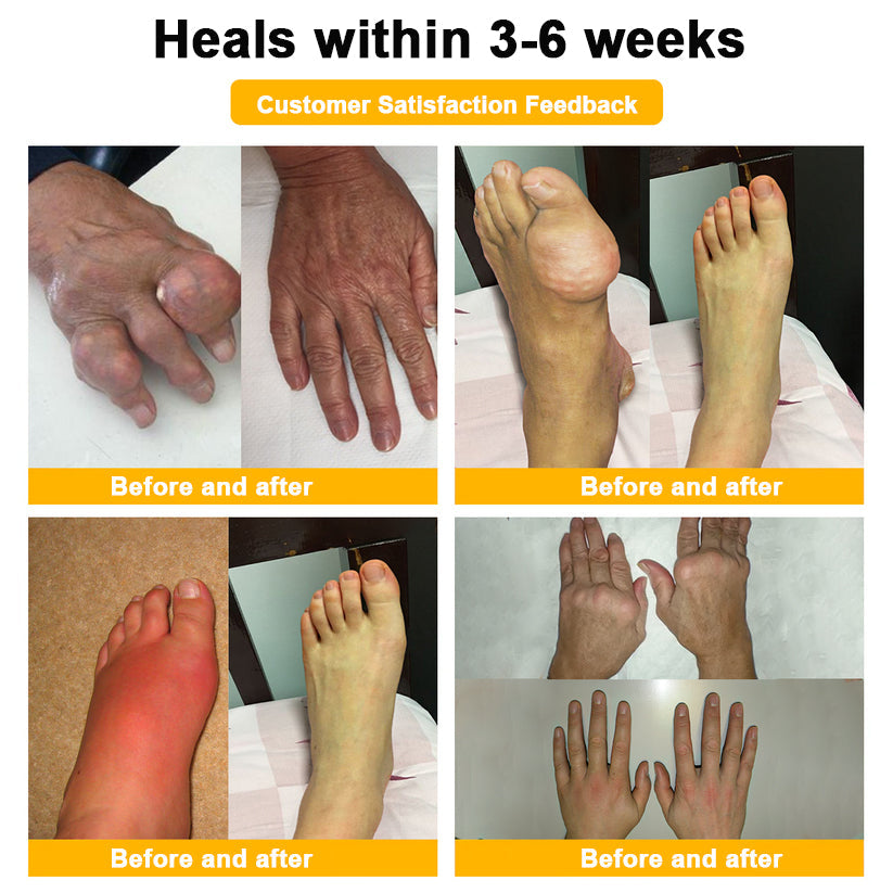 🔥Time-Limited Offer - ODALIT™ Botulinum Toxin & Bee Venom Pain-Relief Bone Healing Cream🐝💎