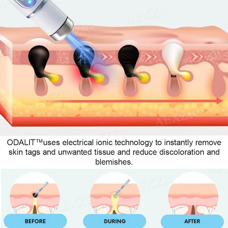 ODALIT™ Non-Invasive Mole and Wart Removal Laser Pen