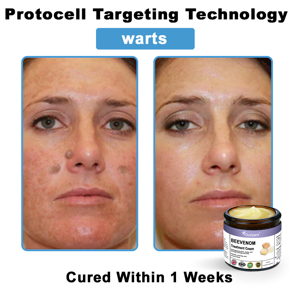 Ourlyard® Bee Venom Skin Treatment Cream👨‍⚕️Treats warts, growths, infections, and scars, smooths uneven skin, and is certified by the British Association of Dermatologists (BAD)