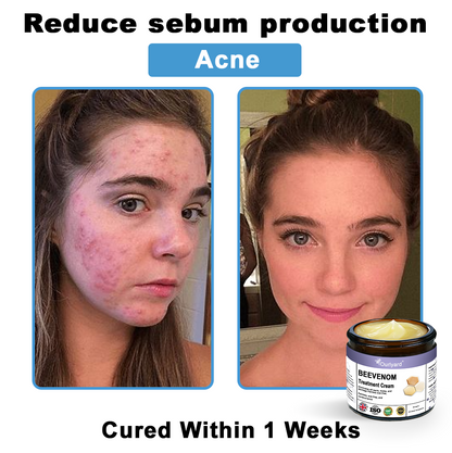 Ourlyard® Bee Venom Skin Treatment Cream👨‍⚕️Treats warts, growths, infections, and scars, smooths uneven skin, and is certified by the British Association of Dermatologists (BAD)