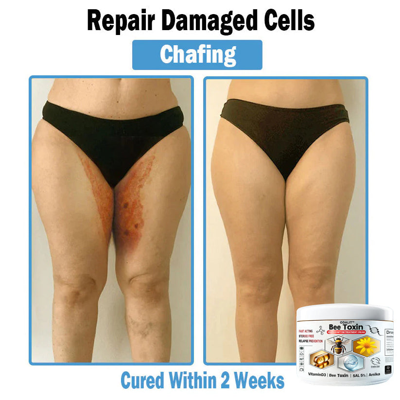 ODALIT™✨ Bee Toxin Multi-Symptom Skin Treatment Cream (👨‍⚕NPF RECOMMENDS)