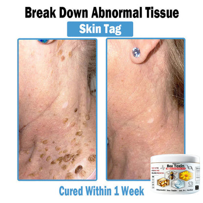 ODALIT™✨ Bee Toxin Multi-Symptom Skin Treatment Cream (👨‍⚕NPF RECOMMENDS)