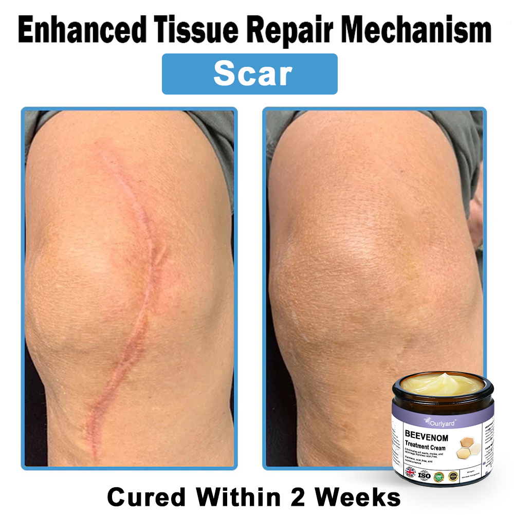 Ourlyard® Bee Venom Skin Treatment Cream👨‍⚕️Treats warts, growths, infections, and scars, smooths uneven skin, and is certified by the British Association of Dermatologists (BAD)