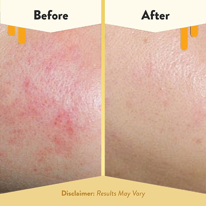 NEGUSY™ Honey Eczema Soothing Cream