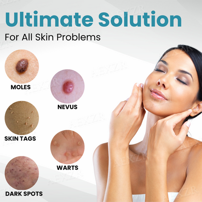 ODALIT™ Non-Invasive Mole and Wart Removal Laser Pen