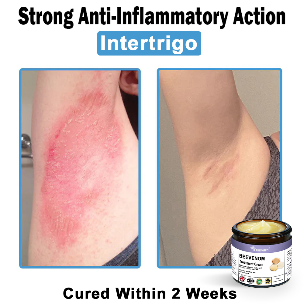 Ourlyard® Bee Venom Skin Treatment Cream👨‍⚕️Treats warts, growths, infections, and scars, smooths uneven skin, and is certified by the British Association of Dermatologists (BAD)